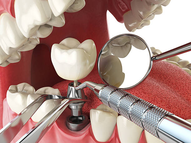 Best Emergency Tooth Extraction in Fairview Shores, FL
